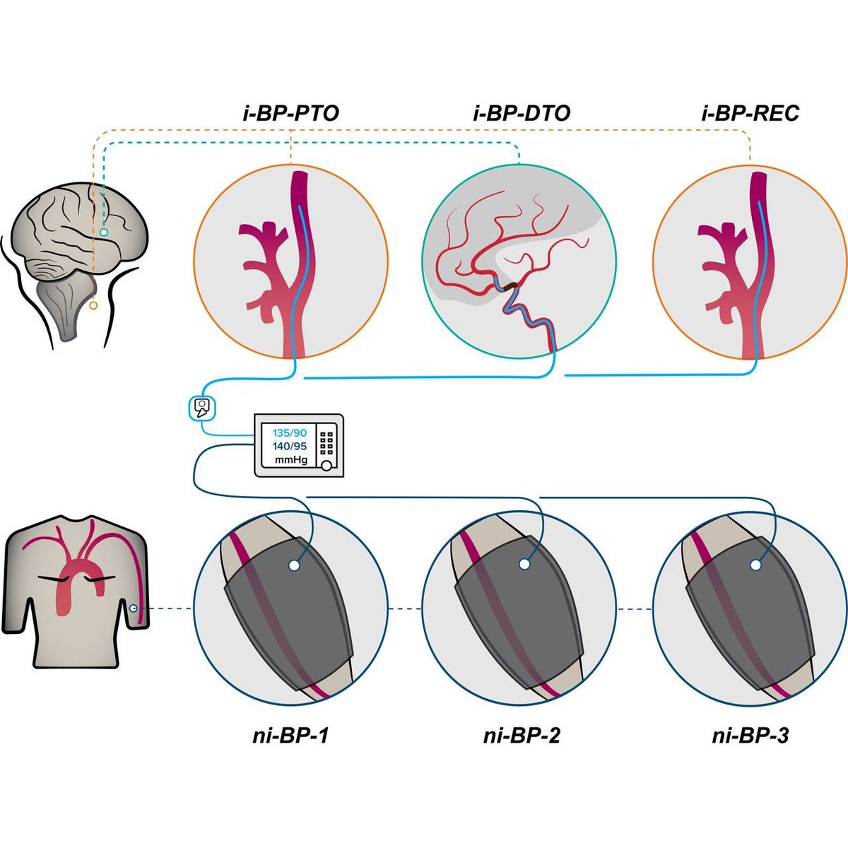 Using a microcatheter system distal to the occluded vessel in patients undergoing mechanical thrombectomy, Umhau et al. recorded blood pressure and this correlated with ischemic core size &amp; clinical severity, but not with collateral flow or outcomes. #StrokeResearch #Thrombectomy