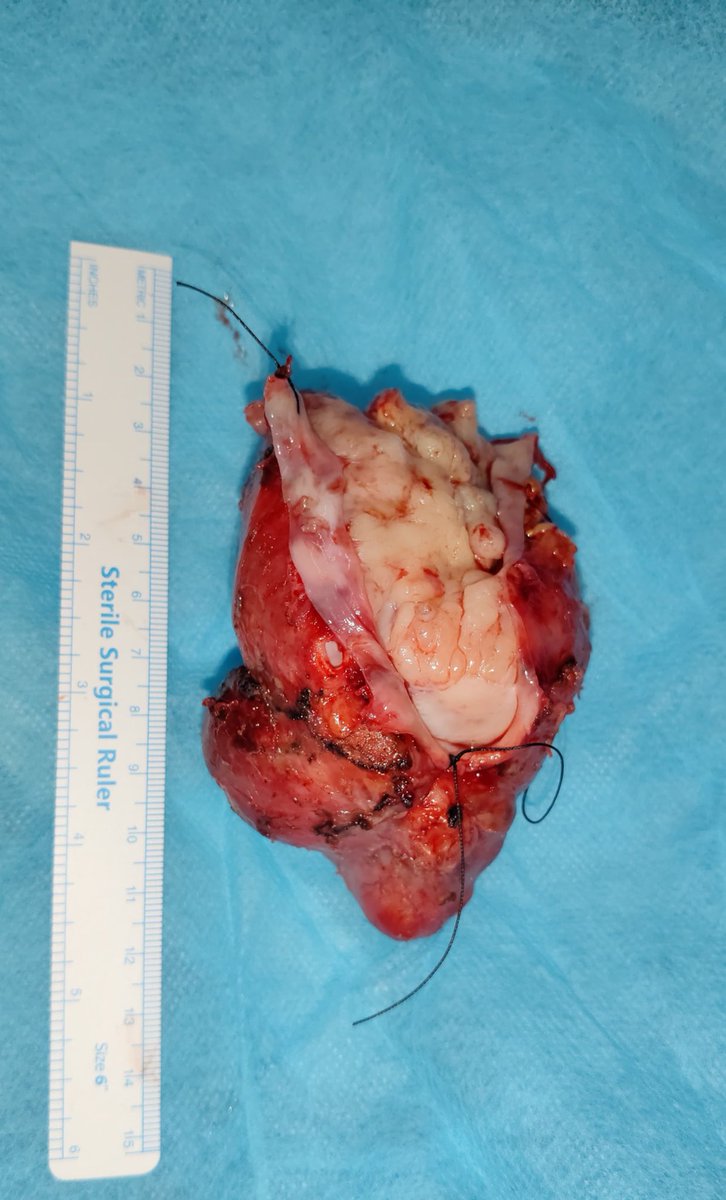 DrPShivanesan (@pshivanesandr) on Twitter photo A 60/F with pain, mass & deranged RFT-S.Creat- 2.7.MRI- IVC tumour from infra renal to Hep V confluence. Replaced under Temp Supra hepatic clamp/ pringles. Bypass to b/l Renal V. Post op RFT normal. bx-leomyosarcoma <a href="/PrajnaKota/">Prajna Kota MS, MCh</a> <a href="/World_fvs/">WFVS</a> <a href="/Vascular_India/">Vascular Society of India</a> A 60/F with pain, mass & deranged RFT-S.Creat- 2.7.MRI- IVC tumour from infra renal to Hep V confluence. Replaced under Temp Supra hepatic clamp/ pringles. Bypass to b/l Renal V. Post op RFT normal. bx-leomyosarcoma <a href="/PrajnaKota/">Prajna Kota MS, MCh</a> <a href="/World_fvs/">WFVS</a> <a href="/Vascular_India/">Vascular Society of India</a>