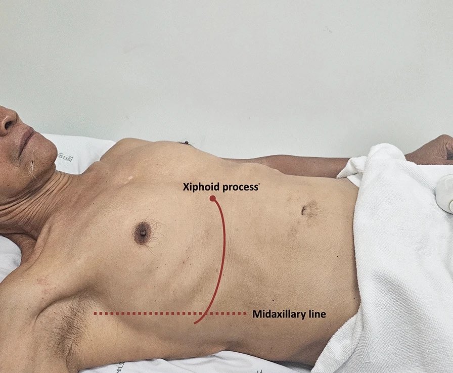 NephroP's tweet photo. Decoding #VExUS: a practical guide for excelling in point-of-care ultrasound assessment of venous congestion.
- @TaweevatA &amp; team
🔗 https://t.co/t3EbtsJusg
#POCUS #FOAMed #Nephpearls https://t.co/nfGvZDgnkP