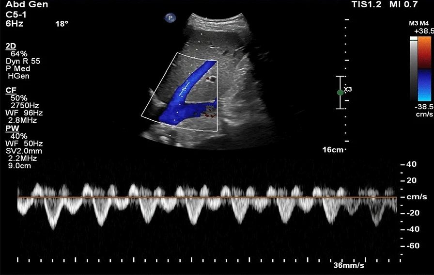 NephroP's tweet photo. Decoding #VExUS: a practical guide for excelling in point-of-care ultrasound assessment of venous congestion.
- @TaweevatA &amp; team
🔗 https://t.co/t3EbtsJusg
#POCUS #FOAMed #Nephpearls https://t.co/nfGvZDgnkP