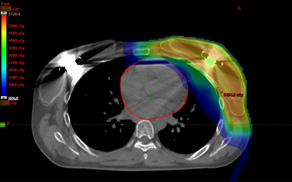 HardenedBeam (@hardenedbeam) on Twitter photo <a href="/5_utr/">M. Bolton</a> Showing you my cases since you think I don't treat breast. 
Here is a left sided PMRT with grossly involved IMNs and expanders - using IMPT with mean heart less than 1Gy while giving 63Gy to the grossly involved IMN node. <a href="/5_utr/">M. Bolton</a> Showing you my cases since you think I don't treat breast. 
Here is a left sided PMRT with grossly involved IMNs and expanders - using IMPT with mean heart less than 1Gy while giving 63Gy to the grossly involved IMN node.