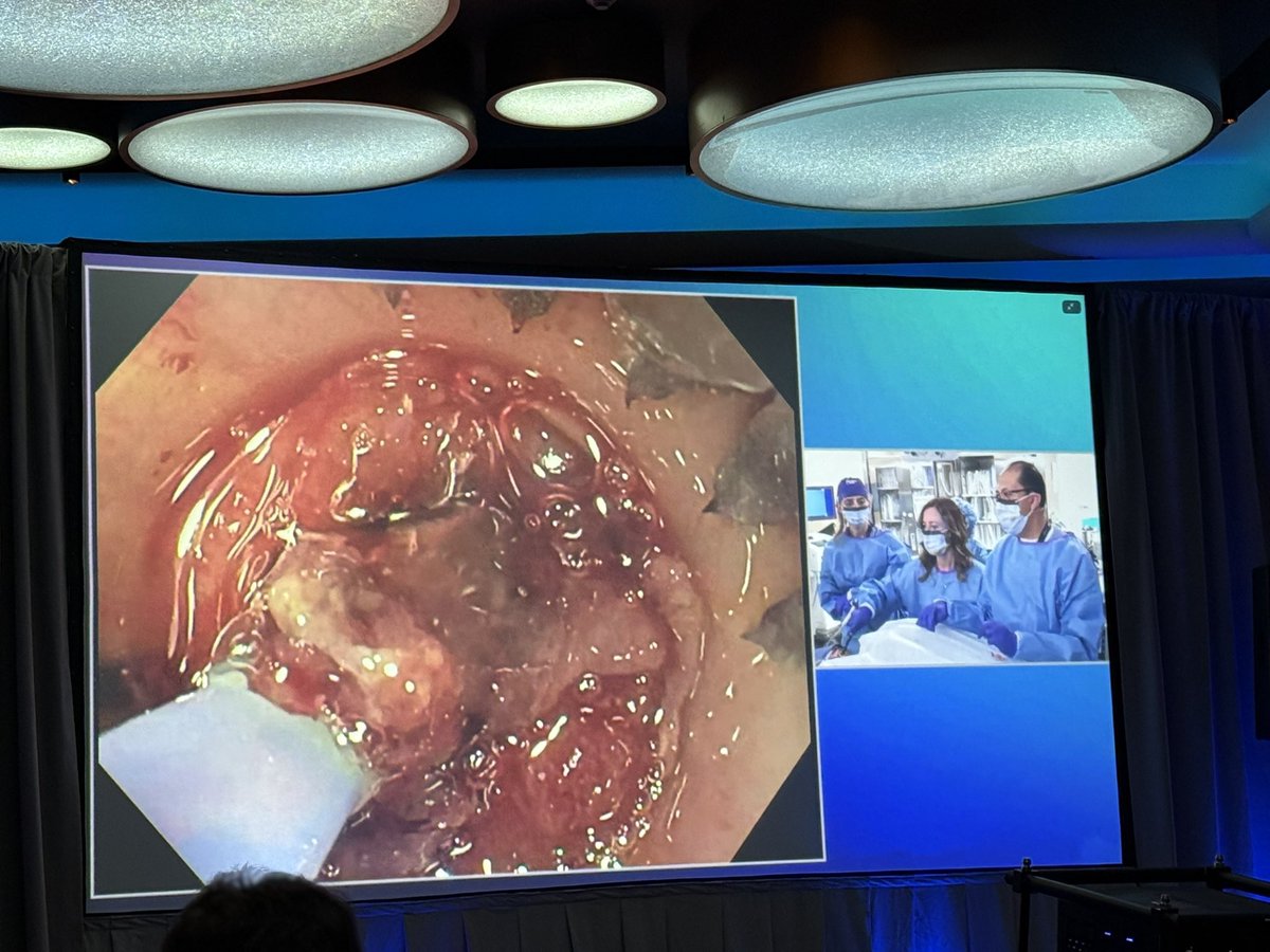 Jessica Widmer (@jesswidmer3) on Twitter photo The NYSGE live course is always the highlight each year for me. Had the best time with my friend, <a href="/shandrawes/">Sherif Andrawes MD</a> closing this gastrogastric fistula with the STAB technique thanks to Dr. Youseff El Douaihy <a href="/NYSGE/">NYSGE</a> <a href="/nyulisom/">NYU Grossman Long Island School of Medicine</a> <a href="/NYULH_GastroHep/">Gastroenterology & Hepatology | NYU Langone Health</a> The NYSGE live course is always the highlight each year for me. Had the best time with my friend, <a href="/shandrawes/">Sherif Andrawes MD</a> closing this gastrogastric fistula with the STAB technique thanks to Dr. Youseff El Douaihy <a href="/NYSGE/">NYSGE</a> <a href="/nyulisom/">NYU Grossman Long Island School of Medicine</a> <a href="/NYULH_GastroHep/">Gastroenterology & Hepatology | NYU Langone Health</a>