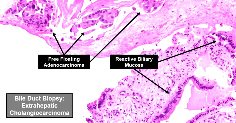 Janiranavarro's tweet image. Bile Duct Biopsy
Extrahepatic Cholangiocarcinoma

Dr. VandenBussche #CAP24 #pathology #PathTwitter #PathX
