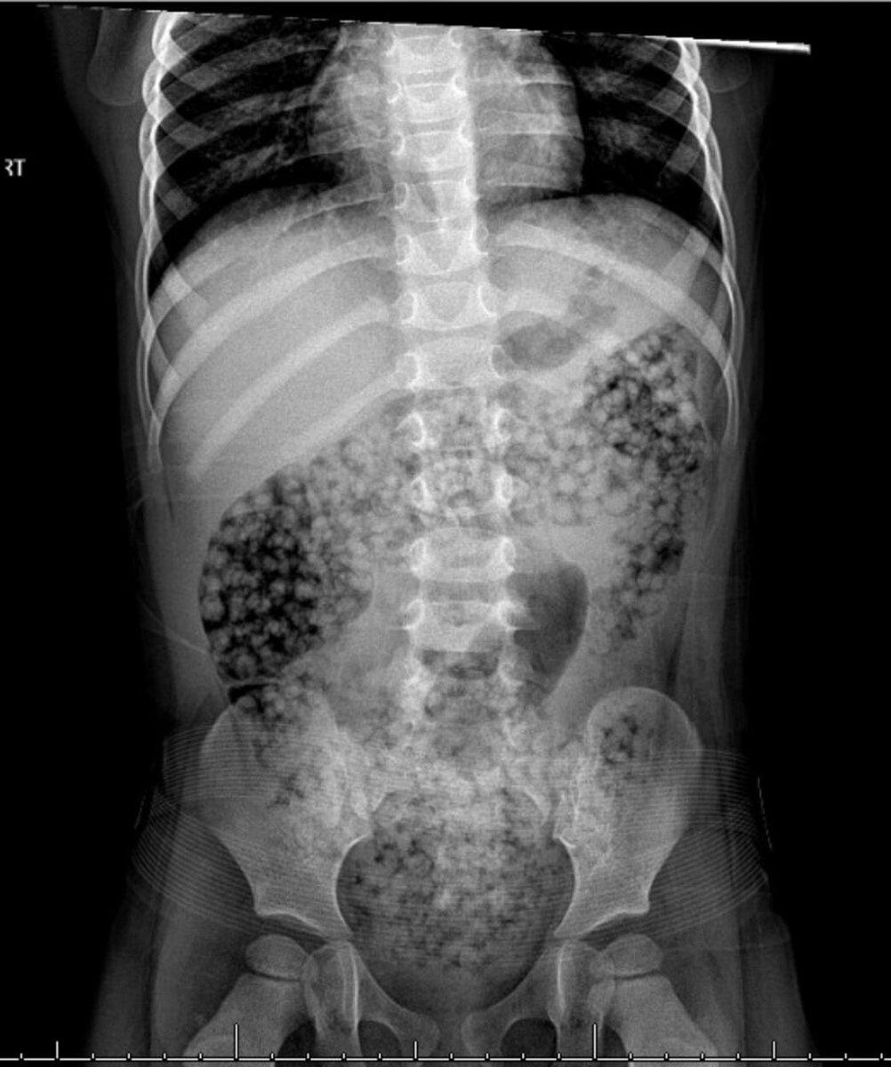 JPGNonline's tweet photo. 🌟 𝗡𝘂𝗺𝗯𝗲𝗿 𝟯🌟 

3yo girl ingested water beads. Now has abdominal pain, emesis. X-ray shows beads in large intestine. First-line management?

https://t.co/KqLpJe8EG4

#imageofthemonth #quickpoll https://t.co/7egNmyQWwI