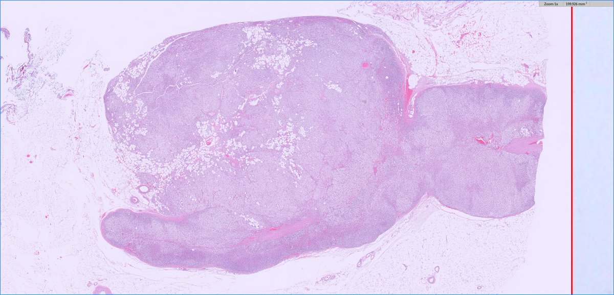 slusagar's tweet image. Q for the #endopath folks for this adrenal cortical adenoma (clinical: primary aldo)

intratumor/adrenal fat I've seen, perhaps not all that uncommon...

but intratumoral/adrenal brown fat? usually I see brown around the peripheral (within background excised fat) when it occurs