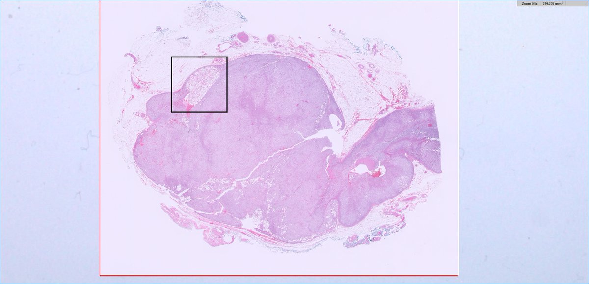 slusagar's tweet image. Q for the #endopath folks for this adrenal cortical adenoma (clinical: primary aldo)

intratumor/adrenal fat I've seen, perhaps not all that uncommon...

but intratumoral/adrenal brown fat? usually I see brown around the peripheral (within background excised fat) when it occurs