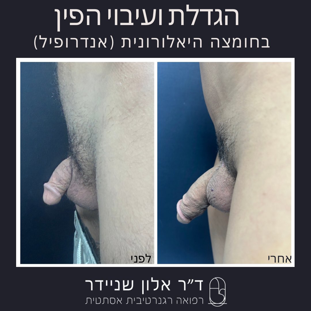 שינוי משמעותי בגודל ועובי הפין בשיטת אנדרופיל!

שדרגו את הביטחון העצמי וההנאה האישית שלכם עם טיפול לעיבוי והגדלת הפין באמצעות חומצה היאלורונית - פתרון מתקדם ובטוח.
👨‍⚕️ מותאם אישית, ללא ניתוח, תוצאות מידיות 
📩 לפרטים נוספים, צרו קשר עכשיו! 
ד״ר אלון שניידר - 053-5582777