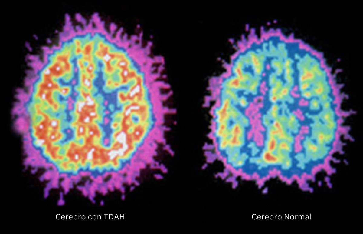 Te han mentido. 

El TDAH no es un trastorno, es una forma diferente en que el cerebro procesa la información. 

Puedes controlarlo naturalmente, sin pastillas para "arreglarlo". 

Esta es la guía paso a paso (basada en ciencia): 🧵
