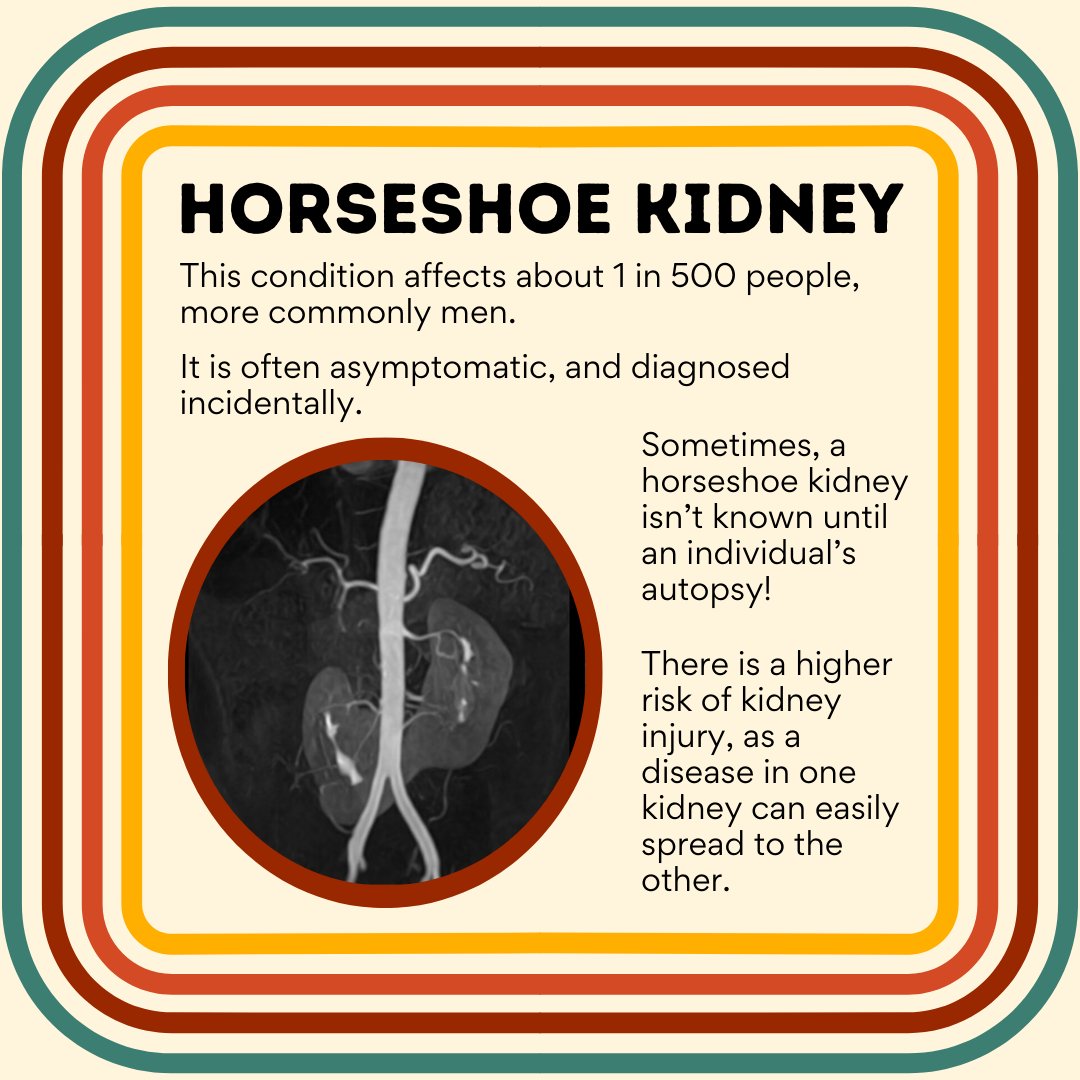 DeKalbCountyME's tweet photo. ⚠️ This post contains a photo of an educational specimen. ⚠️

A horseshoe kidney is a congenital fusion of the left and right kidney at the inferior renal pole. During normal embryonic development, the kidneys usually rise separately into place in the abdomen. https://t.co/iVxn9xSl2w