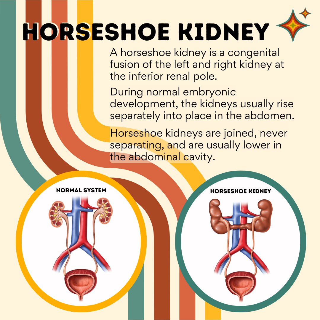 DeKalbCountyME's tweet photo. ⚠️ This post contains a photo of an educational specimen. ⚠️

A horseshoe kidney is a congenital fusion of the left and right kidney at the inferior renal pole. During normal embryonic development, the kidneys usually rise separately into place in the abdomen. https://t.co/iVxn9xSl2w