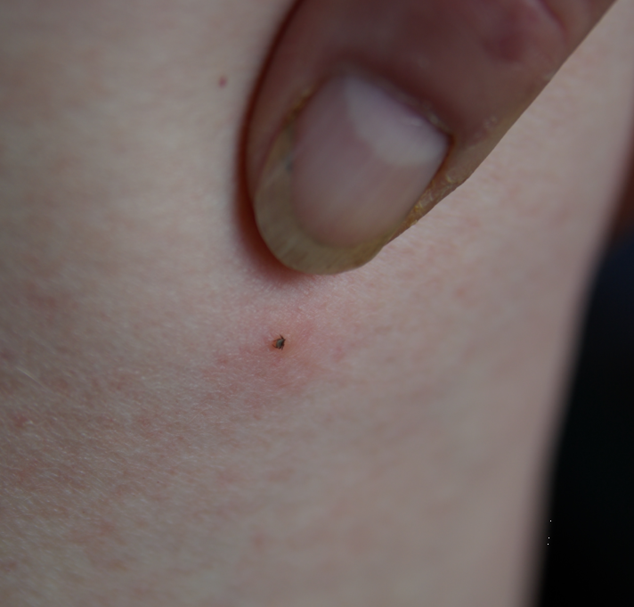 LymeAction's tweet photo. @AEnvy60721 @bmj_latest @BMJPatientEd Not too bad a video, but designed for USA. Here in the UK only maybe 1 in 10 ticks infected, not the 1 in 2 quoted. True - it can be hard to diagnose and awareness of ticks is crucial. Pity he only showed large ones - in reality so tiny &amp; easily missed! https://t.co/4oQFKlBb7J