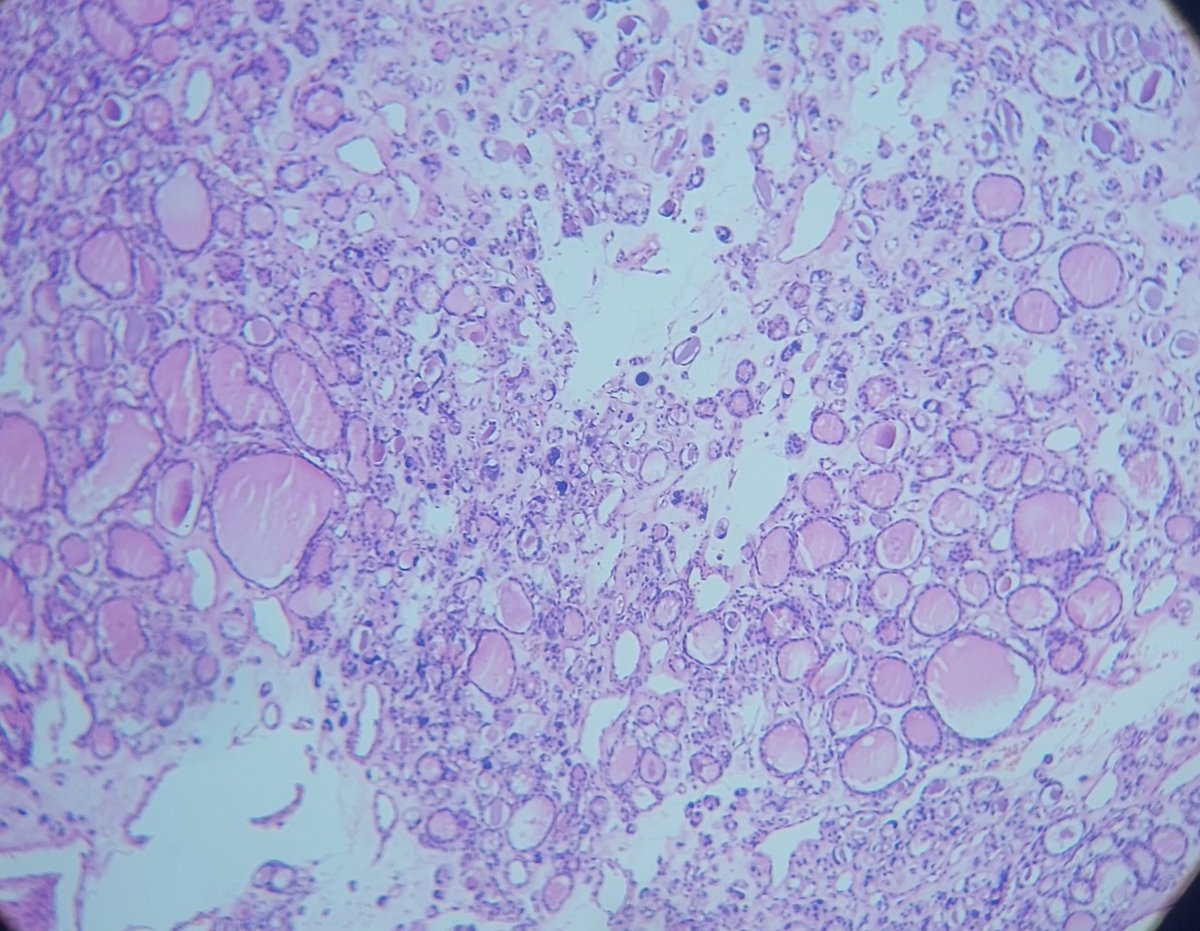 shahidi_hossein's tweet image. M 60s , tumor in right thyroid lobe
DHGTC 
#pathology #Thyroid #endopath #ENTpath