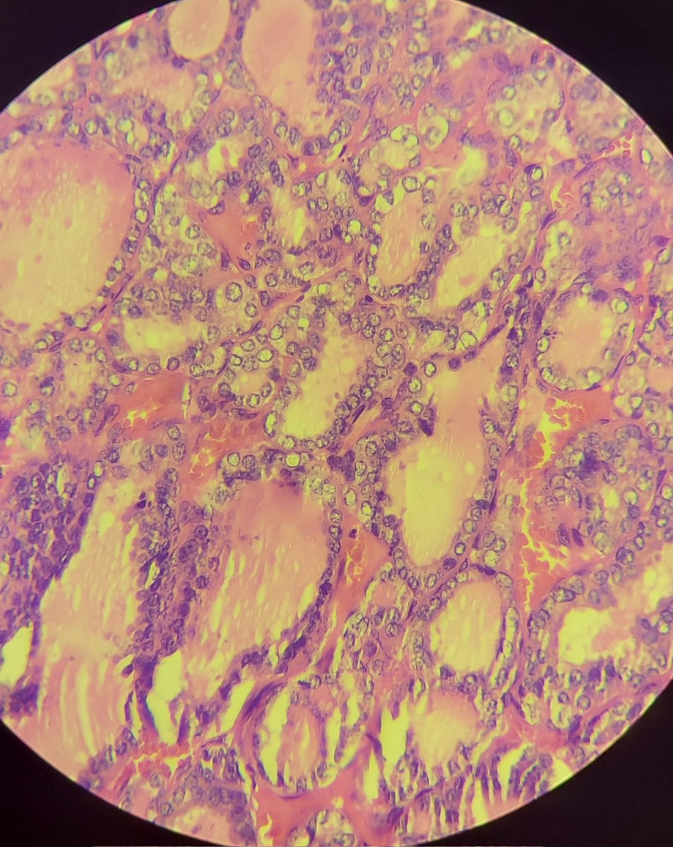 shahidi_hossein's tweet image. M 60s , tumor in right thyroid lobe
DHGTC 
#pathology #Thyroid #endopath #ENTpath