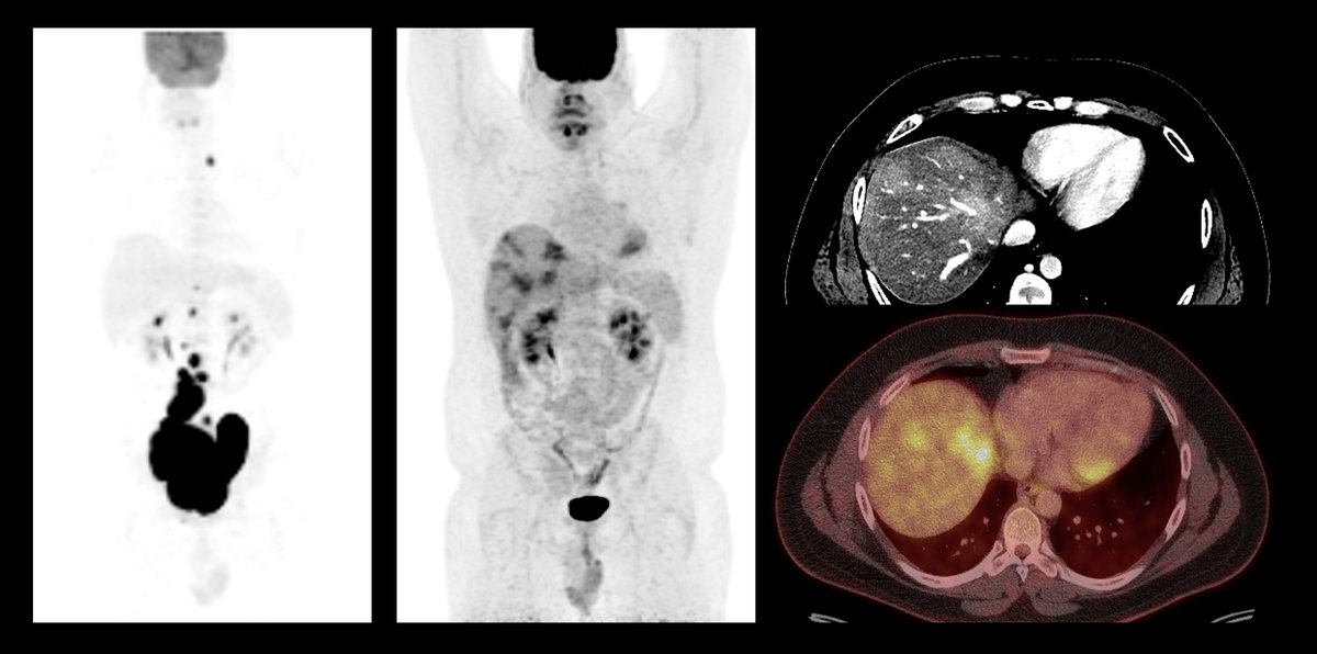 NuclearMD's tweet photo. Lymphoma on FDG PET, followed by post treatment studies. What is the best explanation of liver uptake on post treatment scan: https://t.co/DWiT0ZYNbX