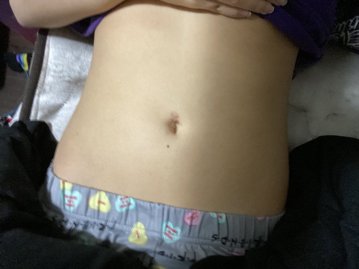 bugskeleton's tweet image. 1 week 6 pounds difference bmi 22.5 to bmi 21.5 do y’all see the difference