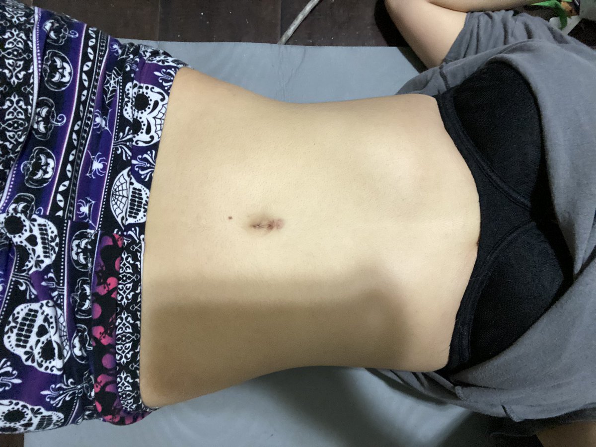 bugskeleton's tweet image. 1 week 6 pounds difference bmi 22.5 to bmi 21.5 do y’all see the difference