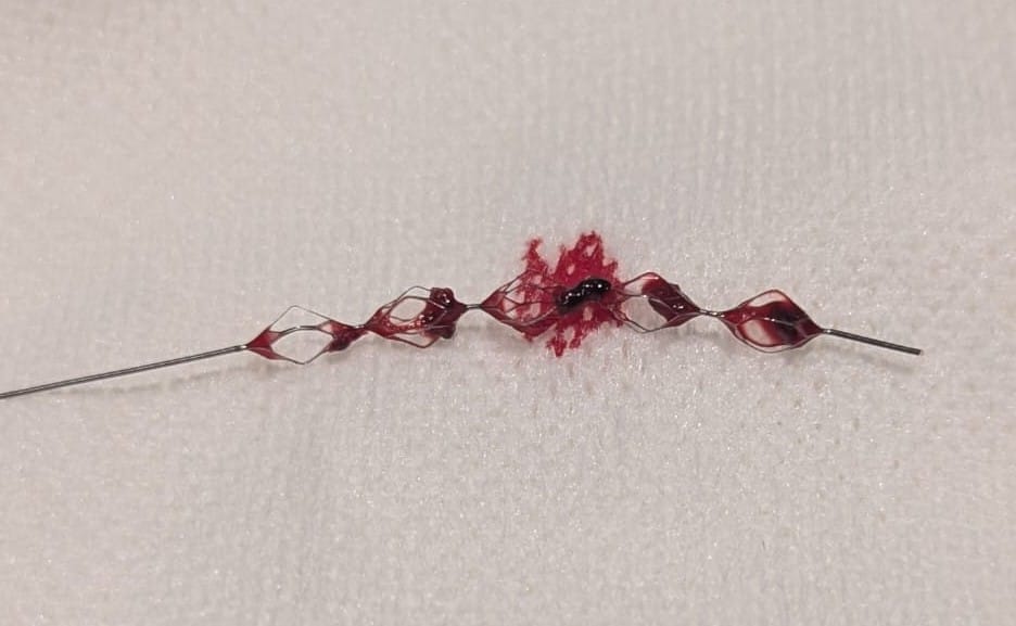 Sachin Pandey (@sachinkishore82) on Twitter photo Another tool for Canadian stroke pts. ERIC has crossed the border. Clot in each cell of the device makes us wonder if device fragments clot or if it helps fully capture an already fragile/fragmented clot.
<a href="/LHSCCanada/">London Health Sciences Centre</a> <a href="/SchulichMedDent/">Schulich WesternU</a> <a href="/westernurad/">Western Radiology</a> <a href="/westernuCNS/">#WesternU CNS</a> <a href="/terumoneuro/">Terumo Neuro</a> Another tool for Canadian stroke pts. ERIC has crossed the border. Clot in each cell of the device makes us wonder if device fragments clot or if it helps fully capture an already fragile/fragmented clot.
<a href="/LHSCCanada/">London Health Sciences Centre</a> <a href="/SchulichMedDent/">Schulich WesternU</a> <a href="/westernurad/">Western Radiology</a> <a href="/westernuCNS/">#WesternU CNS</a> <a href="/terumoneuro/">Terumo Neuro</a>