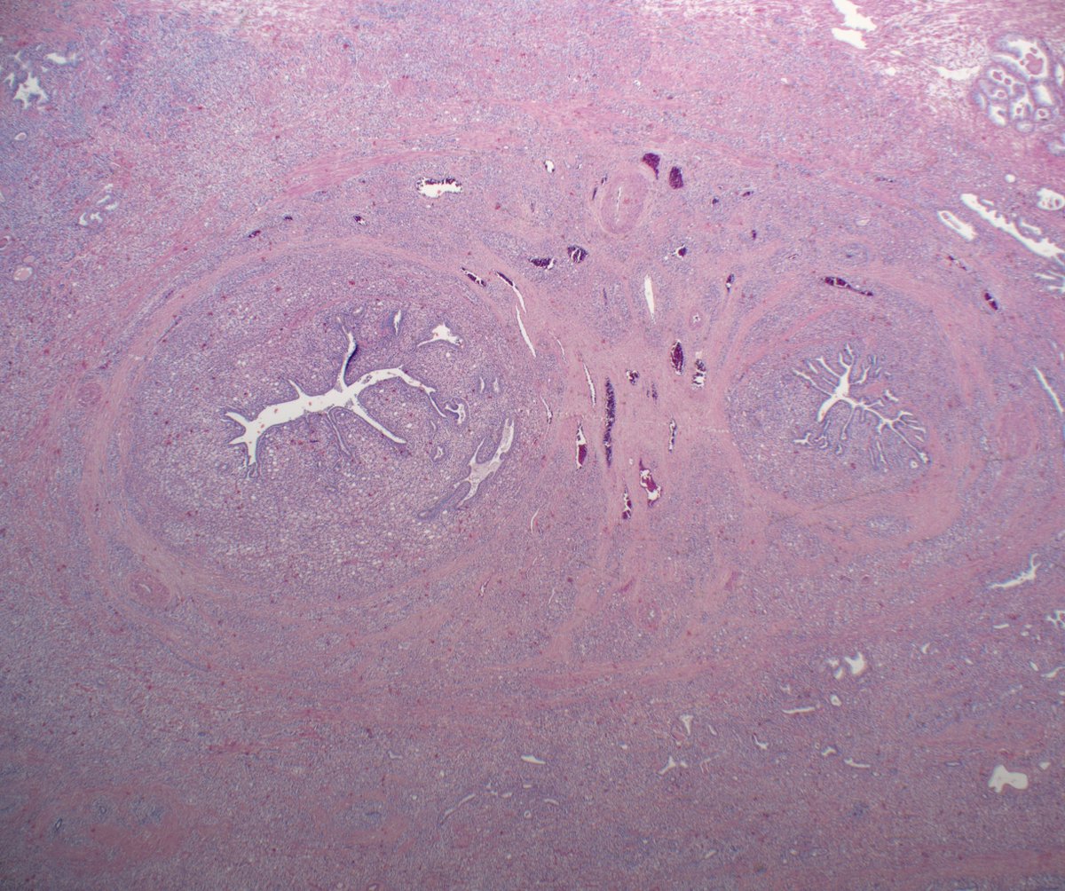 slusagar's tweet photo. #GUpath radical prostatectomy:
ejaculatory duct section
(not technically pT3b here...but not surprisingly showed true SV invasion in other sections)
#pathmeme https://t.co/2tdNF5FbFY