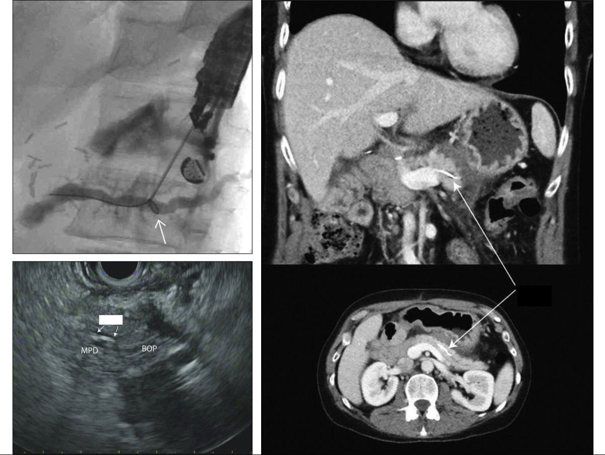 ACGCRJ (@acgcrj) on Twitter photo 🗣️ Image Challenge ⏱️ #ACGCRJ
👉What did you see on images after EUS-Rendezvous procedure?
👉 How would you manage it?
📚bit.ly/3DzHlri
<a href="/AmCollegeGastro/">ACG</a> <a href="/NadeemYousafMD/">Nadeem Yousaf</a> <a href="/PrateekHarne1/">Prateek Harne MBBS, MD</a> <a href="/HZaverMD/">Himesh Zaver, MD</a> <a href="/AbelJosephMD/">Abel Joseph</a>
#GITwitter #MedTwitter #endoscopy #livertwitter 🗣️ Image Challenge ⏱️ #ACGCRJ
👉What did you see on images after EUS-Rendezvous procedure?
👉 How would you manage it?
📚bit.ly/3DzHlri
<a href="/AmCollegeGastro/">ACG</a> <a href="/NadeemYousafMD/">Nadeem Yousaf</a> <a href="/PrateekHarne1/">Prateek Harne MBBS, MD</a> <a href="/HZaverMD/">Himesh Zaver, MD</a> <a href="/AbelJosephMD/">Abel Joseph</a>
#GITwitter #MedTwitter #endoscopy #livertwitter