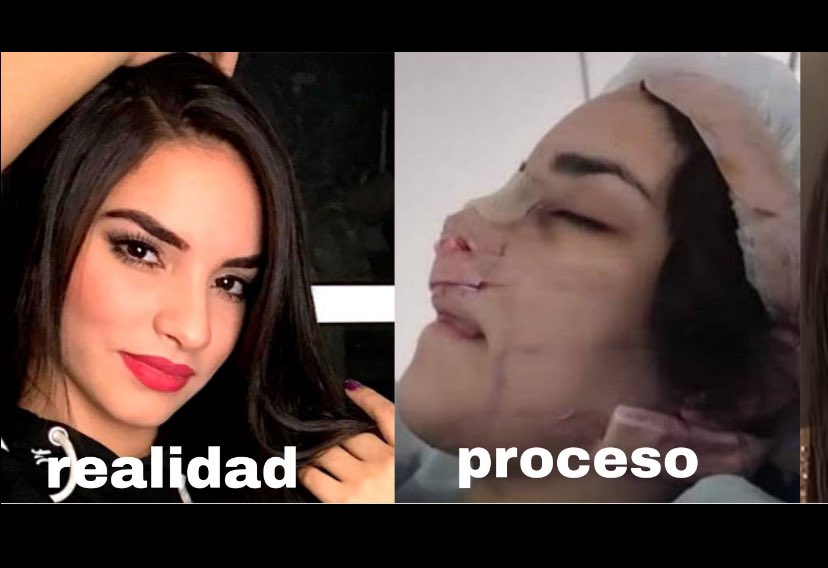 kosluchis's tweet photo. Hablemos de los procedimientos estéticos y operaciones que ha tenido @KimberlyLoaiza_ presumiendo de un cuerpo totalmente falso ante redes, además de burlarse del cuerpo de menores de edad.

Abro hilo de exponiendo a @KimberlyLoaiza_ 

LIKE y RT para que llegue a más publico. https://t.co/7AAlCnAKmj
