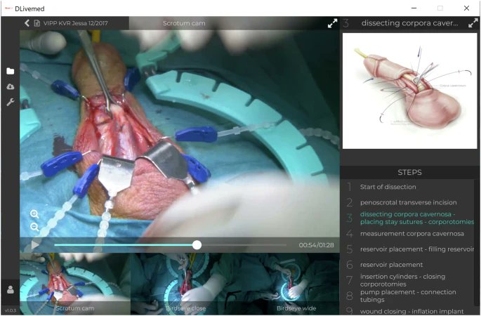 IJIR: Your Sexual Medicine Journal (@yoursexmedjour) on Twitter photo Novel educational concepts in prosthetic urology 👉 nature.com/articles/s4144…
<a href="/KoenraadvanRen1/">Koenraad van Renterghem</a> <a href="/babette_vdyck/">Babette Van dyck</a> <a href="/luytsnoemie/">Noémie Luyts</a> <a href="/UZLeuven/">UZ Leuven</a> Novel educational concepts in prosthetic urology 👉 nature.com/articles/s4144…
<a href="/KoenraadvanRen1/">Koenraad van Renterghem</a> <a href="/babette_vdyck/">Babette Van dyck</a> <a href="/luytsnoemie/">Noémie Luyts</a> <a href="/UZLeuven/">UZ Leuven</a>