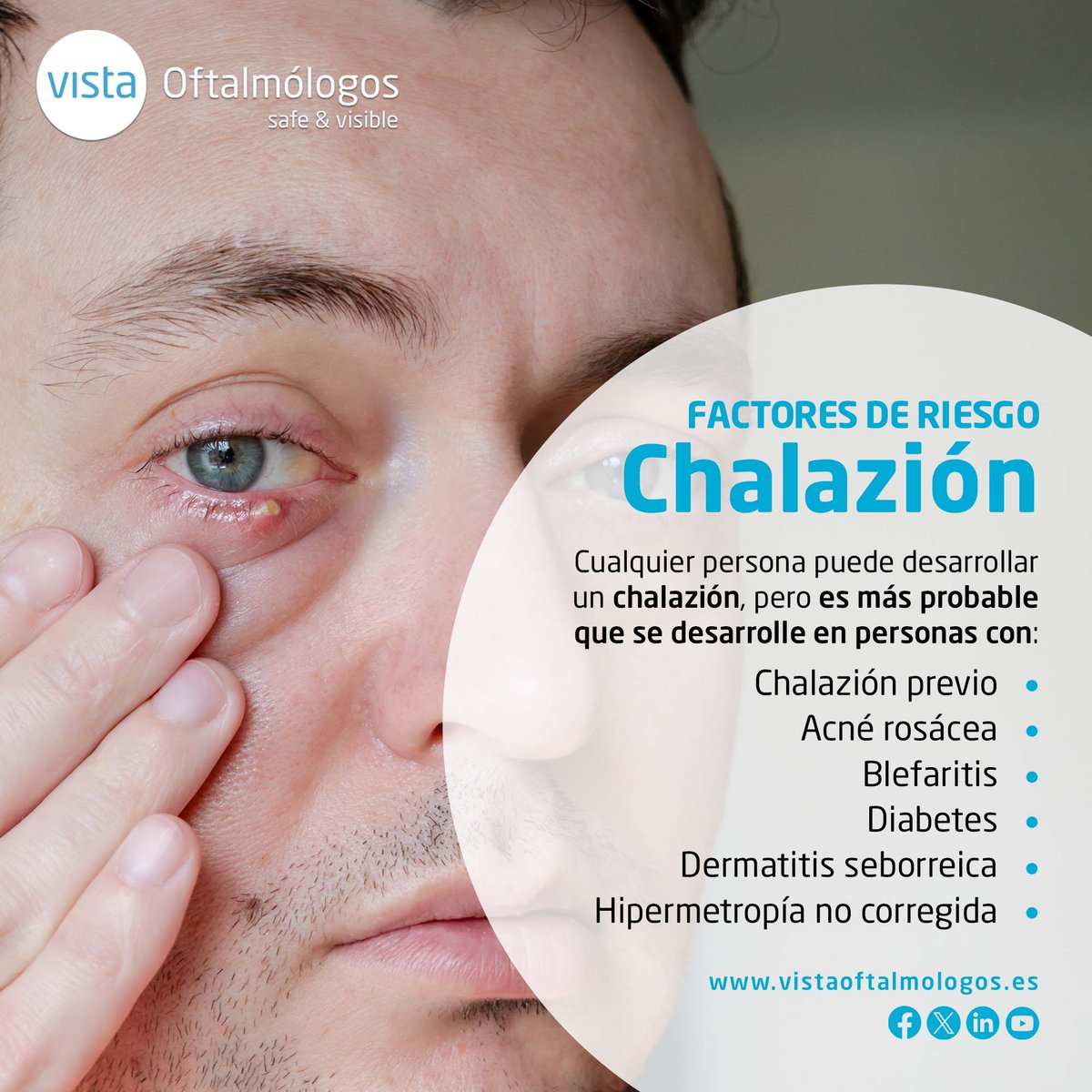 Un #Chalazión, es una protuberancia benigna e indolora en el párpado que aparece cuando se acumulan las secreciones de las glándulas de Meibomio a causa de un bloqueo en el drenaje de las mismas. Hoy os contamos qué personas son más propensas de padecerlo 🤔.
#VistaOftalmólogos