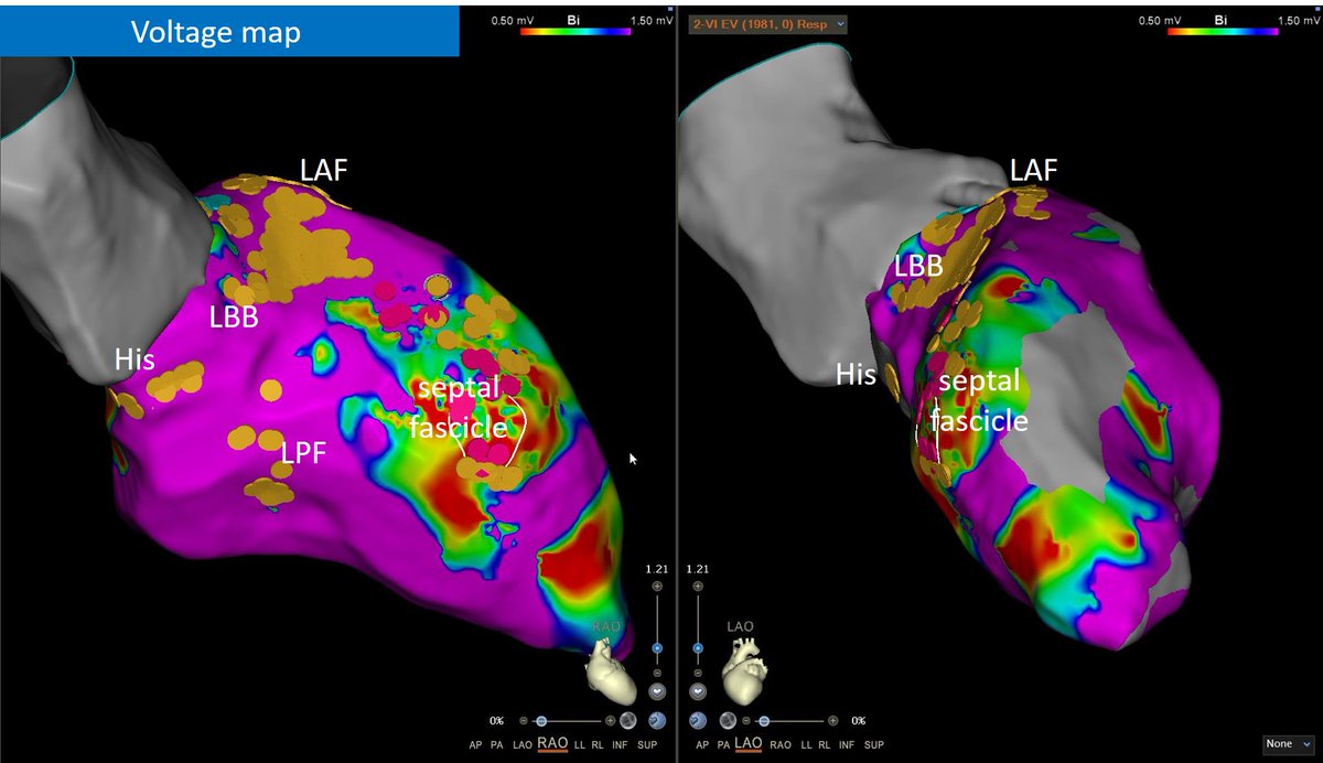 different VENTRICULAR ECTOPY morphologies coming from same area, SEPTAL FASCICLE⚡️on an ischemic patient... angry😡 Purkinje fibers we guess... Optrell as mapping tool #AblateVT #EPeeps