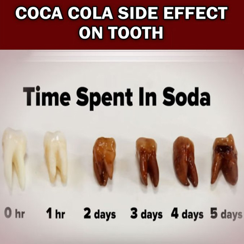 OrganicLiveFood's tweet photo. The Effects of #Soda on Your #Teeth 🦷 The acids in #cocacola attacks the enamel and decrease the hardness. The next layer of the #tooth is dentin, and soda can also damage #dentin. The damage caused to the tooth enamel can increase the risk of #cavities
https://t.co/Sapmlm9MYg
