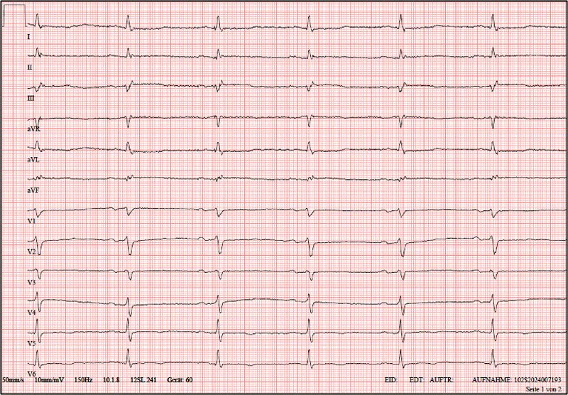PCRonline 🫀 (@pcronline) on Twitter photo When it comes to the strategy and toolbox 🧰 for treating a patient with chronic kidney disease and heavily #calcified multivessel disease, less can sometimes be more.
View part 1⃣ of this #Euro4C case from <a href="/andreka_judit/">Judit Andréka</a>, <a href="/gabor_gt/">Gabor G Toth</a> and Sascha Pätzold and tell us what you would When it comes to the strategy and toolbox 🧰 for treating a patient with chronic kidney disease and heavily #calcified multivessel disease, less can sometimes be more.
View part 1⃣ of this #Euro4C case from <a href="/andreka_judit/">Judit Andréka</a>, <a href="/gabor_gt/">Gabor G Toth</a> and Sascha Pätzold and tell us what you would