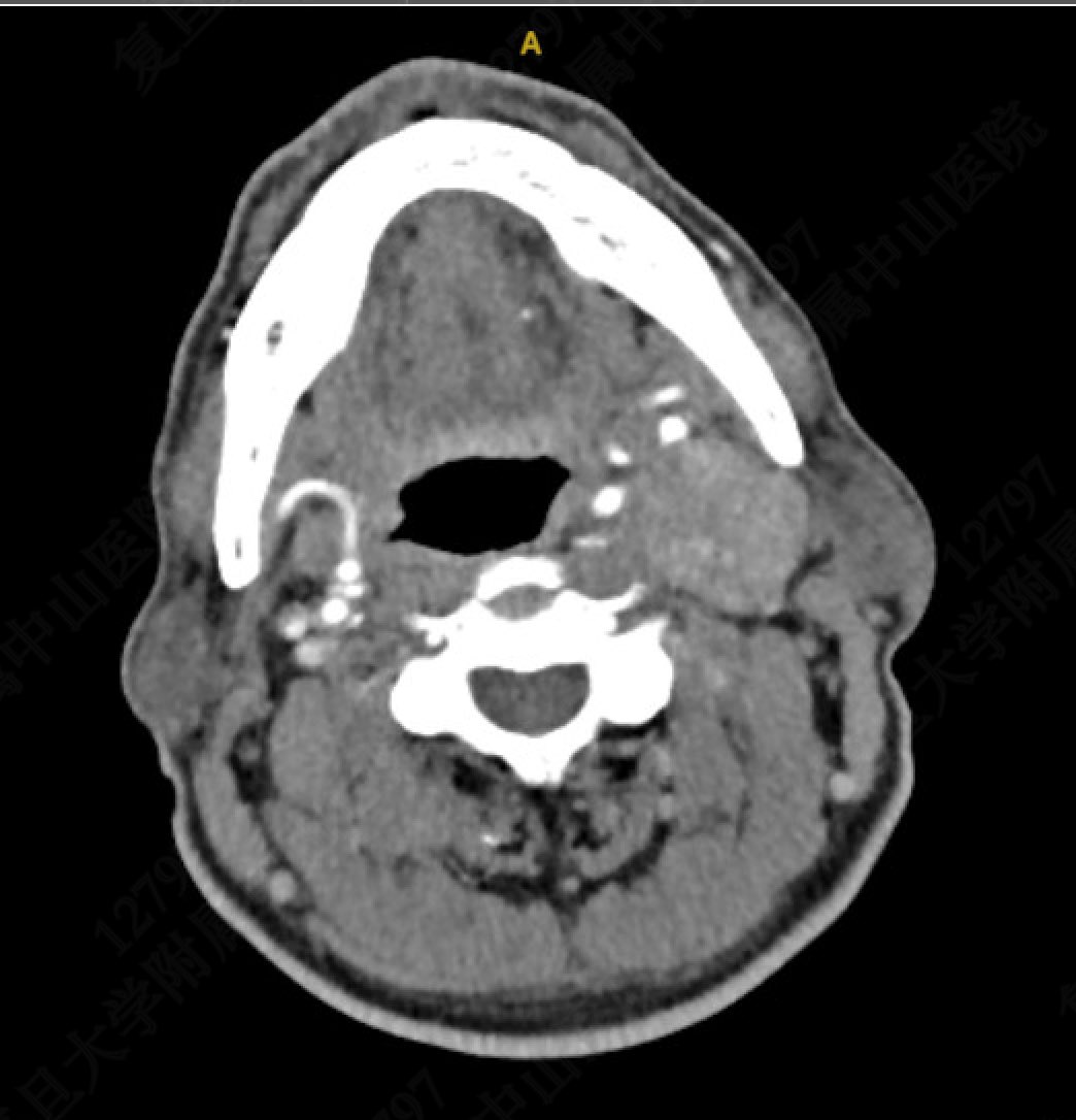 yuejianing's tweet photo. Rare Case: Carotid body tumor (paraganglioma), vagal paraganglioma, and moderate-to-severe carotid artery stenosis occurring on the same side in a single patient.

The procedure included: excision of both tumors, carotid endarterectomy (CEA), and partial resection of the vagus nerve with great auricular nerve grafting.

Postoperatively, the patient experienced hoarseness but no coughing or swallowing difficulties.