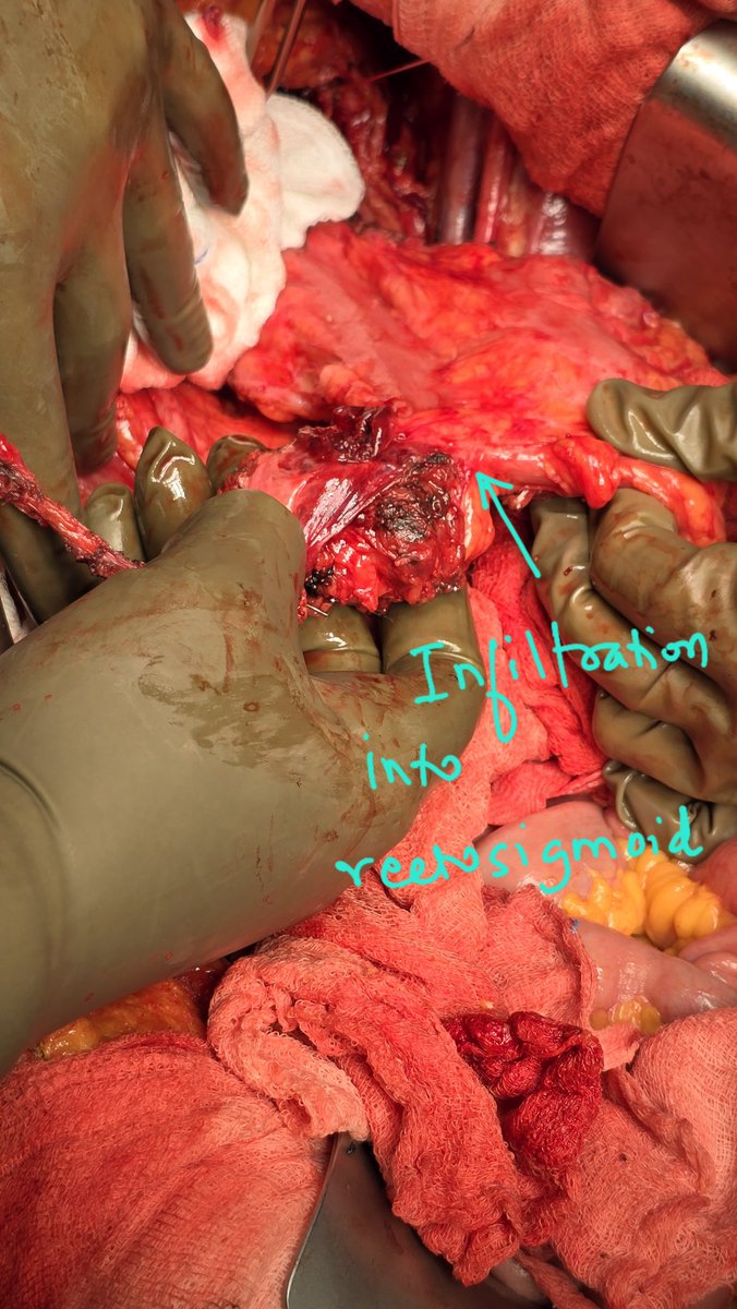 Praveen Kammar (@drpraveenkammar) on Twitter photo 50,PDS ( ?CC score ?quality)ā¶ļøAdj.chemo
platinum free-13months
?recurrence at vault ( ca125 gradually š¼, but WNL)
Intraop- no peritoneal disease
call it ?recurrence
HIPEC?
two recent trails CHIPOR & HORSE in recurrence
<a href="/PSOGI_EC/">Peritoneal Surface Oncology Group International</a> <a href="/writeslkpushkin/">Aditi Bhatt</a> 50,PDS ( ?CC score ?quality)ā¶ļøAdj.chemo
platinum free-13months
?recurrence at vault ( ca125 gradually š¼, but WNL)
Intraop- no peritoneal disease
call it ?recurrence
HIPEC?
two recent trails CHIPOR & HORSE in recurrence
<a href="/PSOGI_EC/">Peritoneal Surface Oncology Group International</a> <a href="/writeslkpushkin/">Aditi Bhatt</a>
