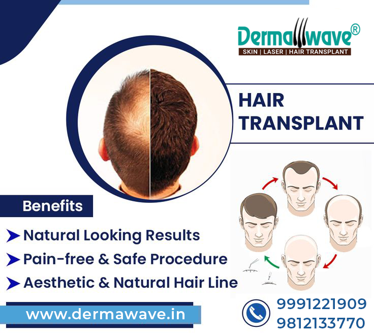 DermawaveHT's tweet photo. DERMAWAVE FUE HAIR TRANSPLANT CENTRE
Best hair transplant clinic in panipat, delhi, patna, ranchi, jammu, ghaziabad, kurukshetra.
Visit dermawave for high density hair transplant results. Call us 9991221909 or https://t.co/hun3VE23UI
 #hairtransplantresults
#hairtransplantindia https://t.co/HozHz9q0JP