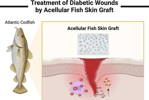 DGArmstrong's tweet image. Acellular fish skin grafts in the treatment of diabetic wounds: Advantages and clinical translation #ActAgainstAmputation #FishSkin diabeticfootonline.com/2024/04/28/ace…