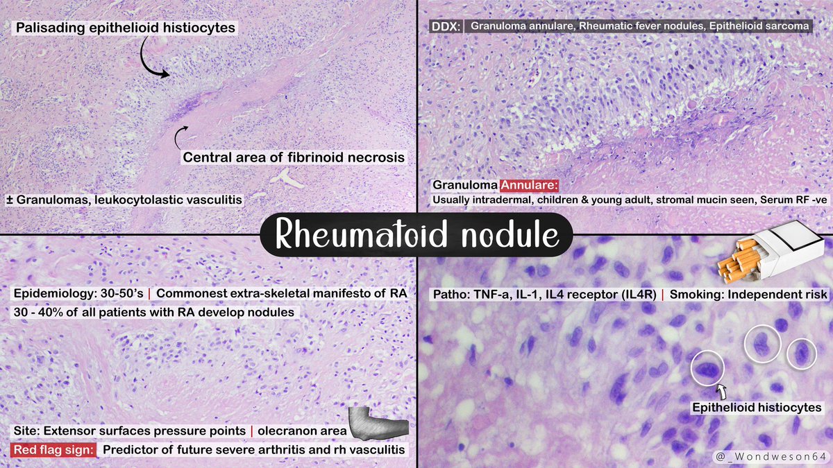 🔬Diagnosis &amp; Bite sized Pearl | Previous Case!
➱ RHEUMATOID NODULE
#BSTpath #Pathresidents #PathTwitter #pathx <a href="/Pathologists/">CAPathologists</a> <a href="/Pathology_mcqs/">Pathology mcqs</a> <a href="/AceMyPath/">Ace My Path</a>