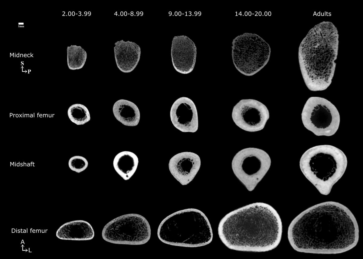 The properties of femoral midneck cross-sections exhibit a unique growth pattern characterized by shape changes during adolescence. 
New study by Julia Muñoz-Guarinos et al.: buff.ly/3Dx1T3I