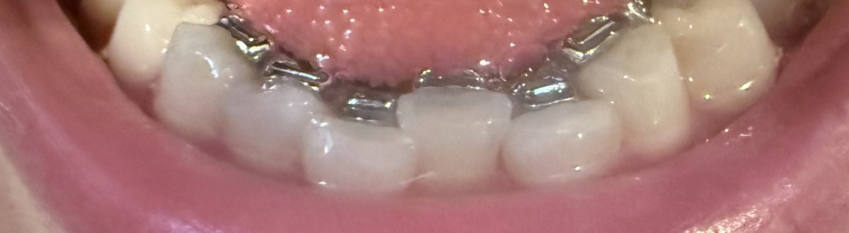 c1mm4's tweet photo. もともと歯が小さくてコンプレックスで、親知らずが生えたことで歯並びが歪んでしまって更にコンプレックスに😢
骨格的に歯が小さく生えてきてしまったから仕方ないから諦めてるけど、歯並びだけでも早く綺麗になりますように😢 https://t.co/lbe9qfCPxA
