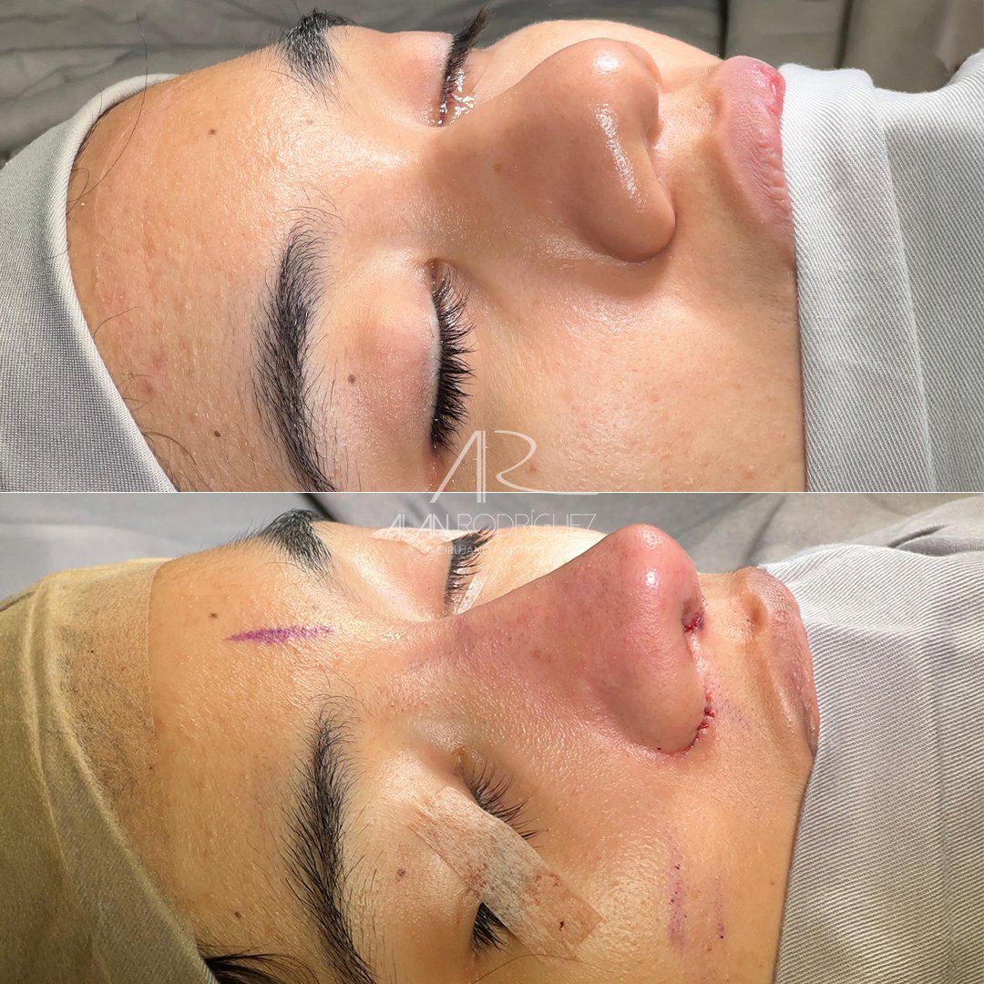 dr_alanrodri's tweet photo. Rinoplastia primaria: piel gruesa, radix bajo, dorso ancho, punta bulbosa y mal definida con retracción en base de columela.

🌟 ¡Transforma tu nariz con el mejor equipo en BQ!
💬 WA: +57 317 822 6364
☎ +57 (5) 3100620
#dralanrodriguez #rinoplastia #cirugiaplastica #belleza https://t.co/LaDftmfWUD