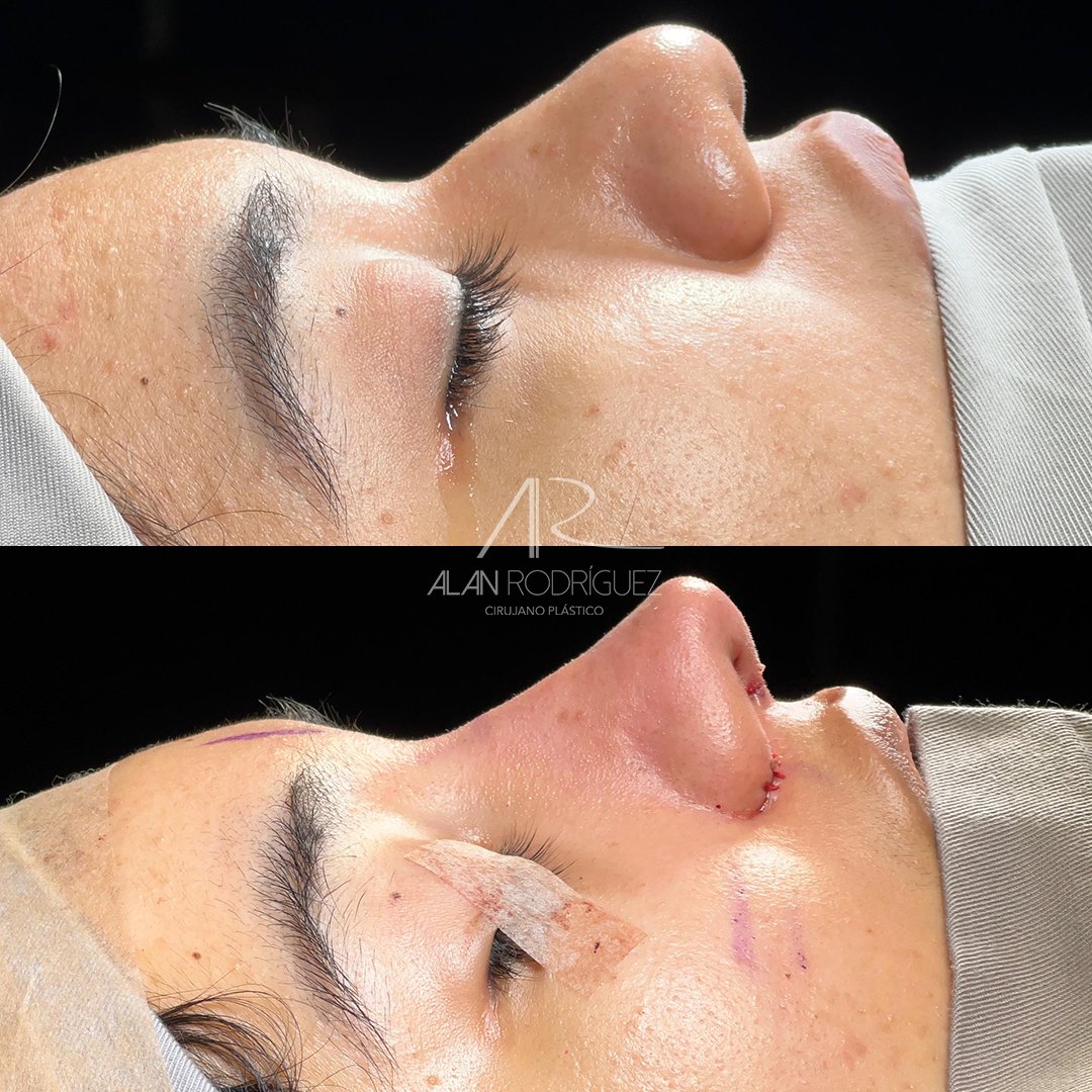 dr_alanrodri's tweet photo. Rinoplastia primaria: piel gruesa, radix bajo, dorso ancho, punta bulbosa y mal definida con retracción en base de columela.

🌟 ¡Transforma tu nariz con el mejor equipo en BQ!
💬 WA: +57 317 822 6364
☎ +57 (5) 3100620
#dralanrodriguez #rinoplastia #cirugiaplastica #belleza https://t.co/LaDftmfWUD