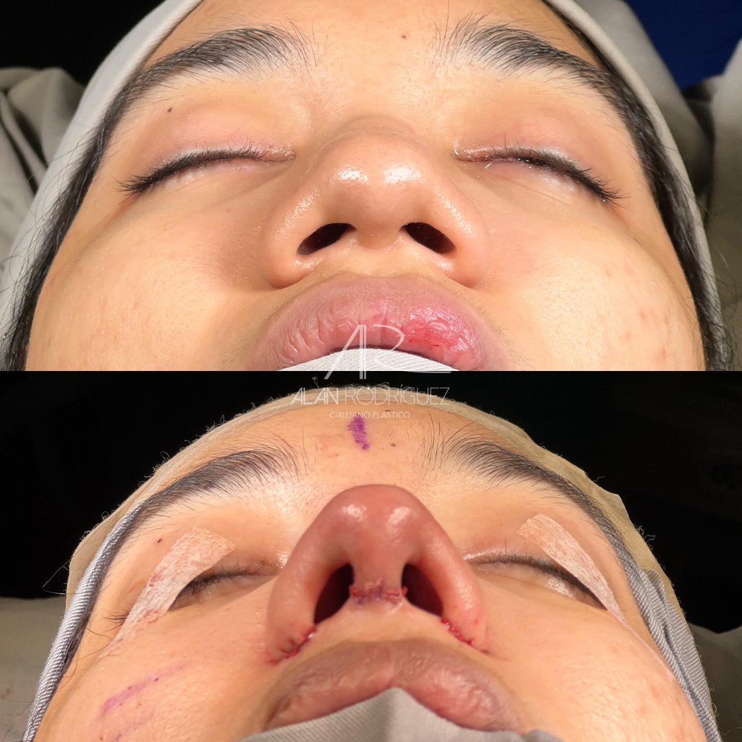 dr_alanrodri's tweet photo. Rinoplastia primaria: piel gruesa, radix bajo, dorso ancho, punta bulbosa y mal definida con retracción en base de columela.

🌟 ¡Transforma tu nariz con el mejor equipo en BQ!
💬 WA: +57 317 822 6364
☎ +57 (5) 3100620
#dralanrodriguez #rinoplastia #cirugiaplastica #belleza https://t.co/LaDftmfWUD
