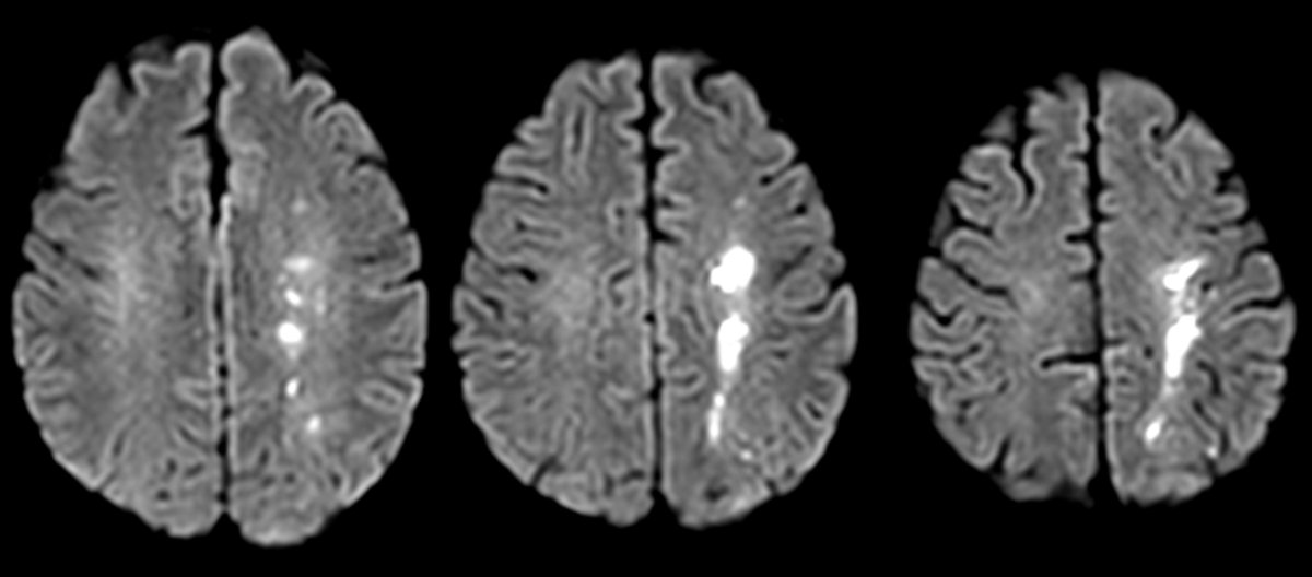 Nirmal Pandey MD DM Neurologist tweet media