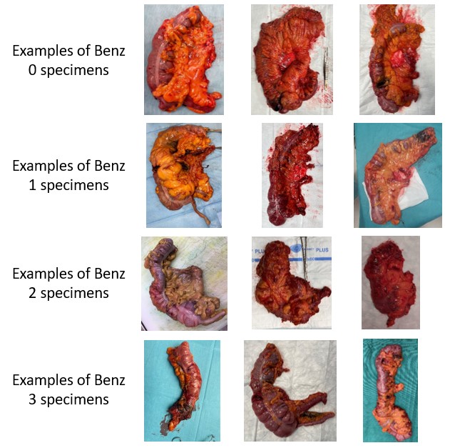 🇳🇱Nationwide variations in the execution of minimally invasive right hemicolectomy and short-term outcomes: first phase of the RIGHT study
➡️ doi.org/10.1093/bjs/zn…

This first phase of the RIGHT study shows that, in the participating hospitals, a high percentage of minimally
