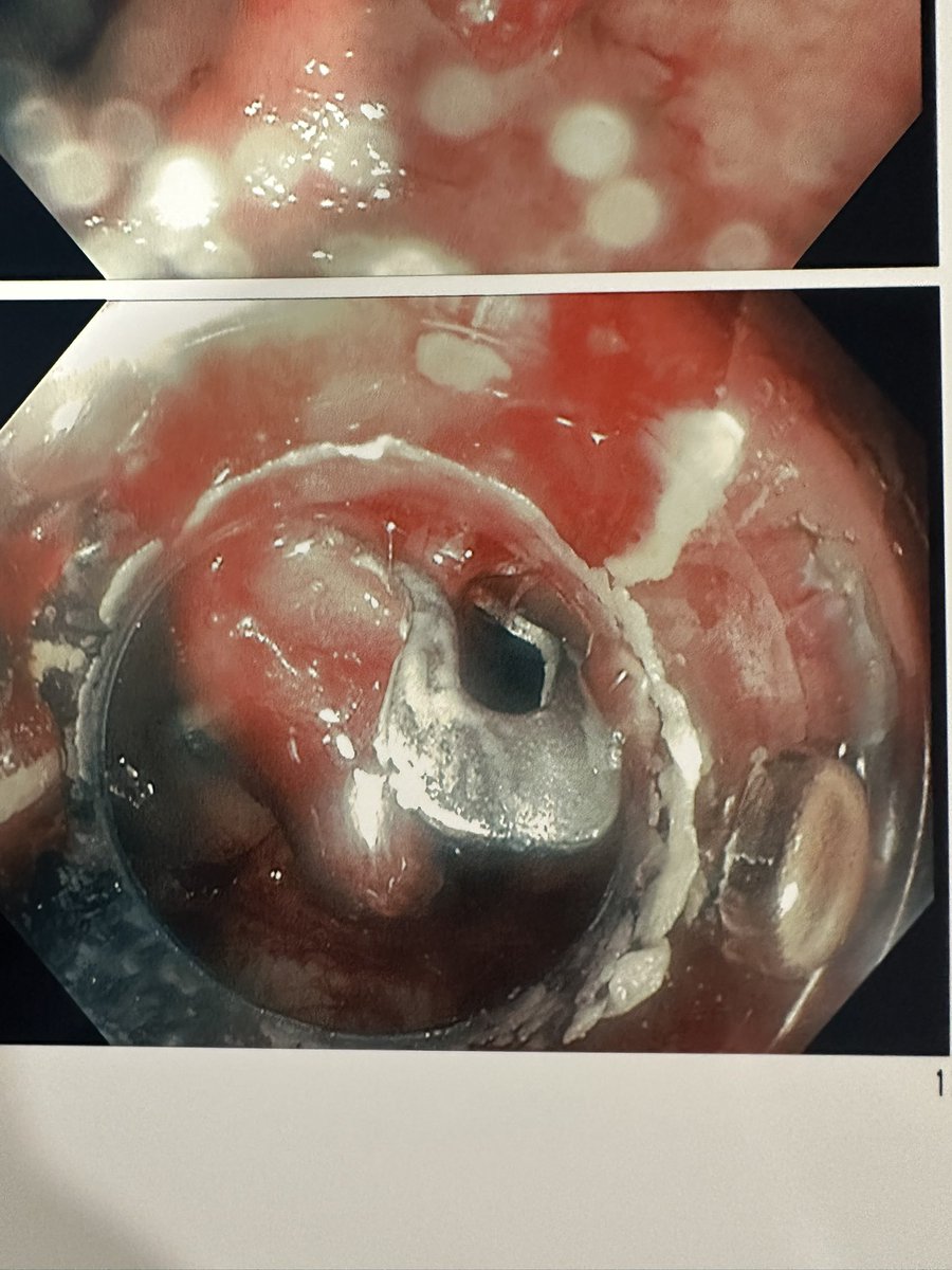 Wassem (Wass) Juakiem #wassupscoping (@wjuakiem) on Twitter photo When it comes to arterial bleeding in the rectum, Ovesco clips outshine standard TTS clips! 🌟 With superior hemostasis, precision placement, and stronger retention, they’re a game changer! <a href="/OvescoEndoscopy/">Ovesco Endoscopy</a> #GItwitter When it comes to arterial bleeding in the rectum, Ovesco clips outshine standard TTS clips! 🌟 With superior hemostasis, precision placement, and stronger retention, they’re a game changer! <a href="/OvescoEndoscopy/">Ovesco Endoscopy</a> #GItwitter