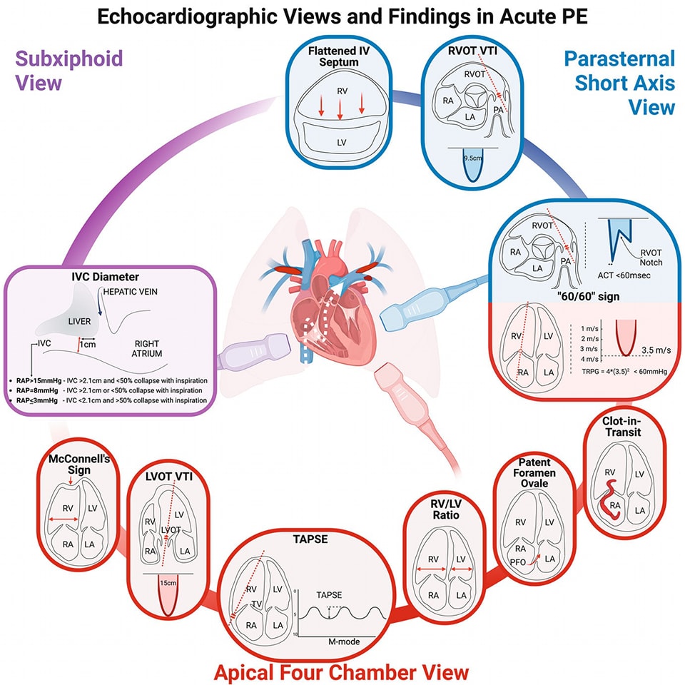 Tomas_MA_Cardio's tweet image. Ecocardiograma en tromboembolia pulmonar.
Resumen gráfico de los hallazgos en cada vista ecocardiográfica.
#echofirst #CardioTwitter #CardioEd @ANCAM_MEXICO @smexcardiologia @SIAC_cardio @SISIACOficial @SONECOM_AC  link.springer.com/referenceworke…