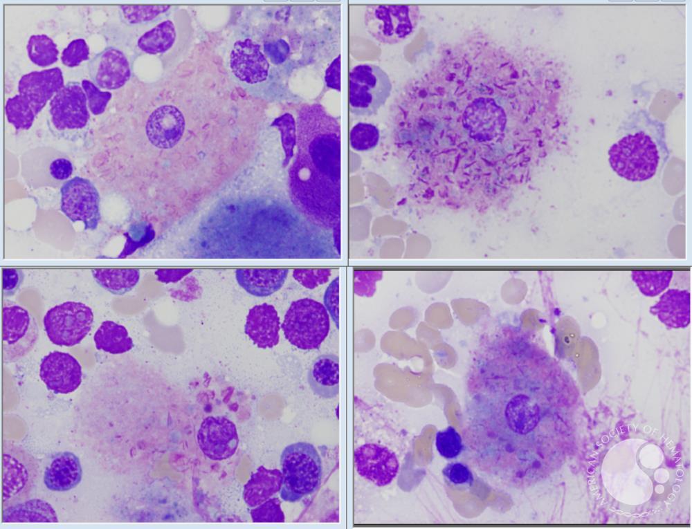 smbenlazar's tweet image. AUER RODS IN HISTIOCYTES AFTER TREATMENT OF ACUTE PROMYELOCYTIC LEUKEMIA. | ASH Image Bank | American Society of Hematology imagebank.hematology.org/image/63625/au… #ASHImageBank