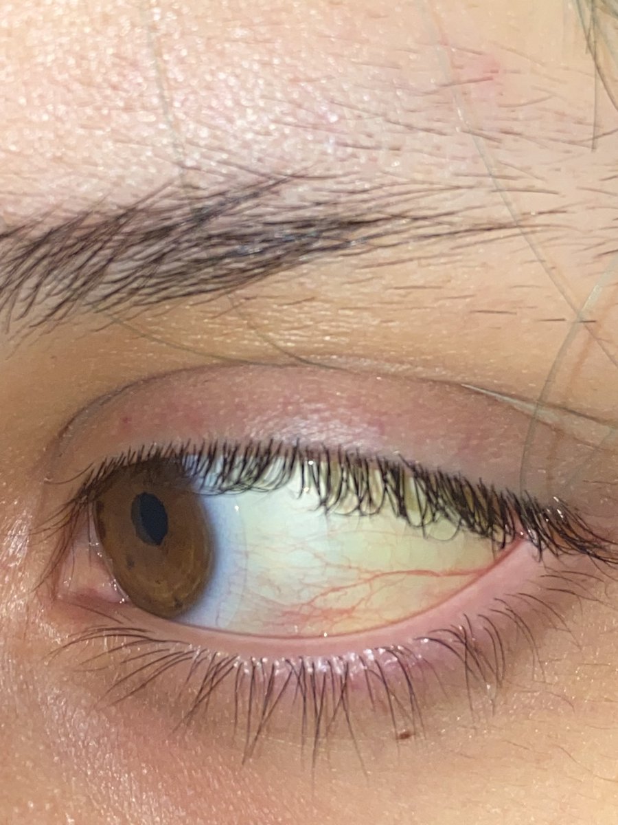 bugskeleton's tweet image. I had to stop fasting because my eyes were turning yellow and I got scared