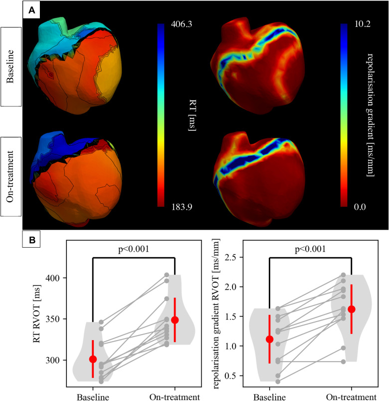 Drug effect with #ECGI 🫶

Noninvasive assessment of hydroquinidine effect in Brugada syndrome (QUIET BrS)

Julia C. Isbister, <a href="/DrStrocchi/">Marina</a>, Steven A. Niederer, Raymond W. Sy. et al. 🇦🇺🇬🇧