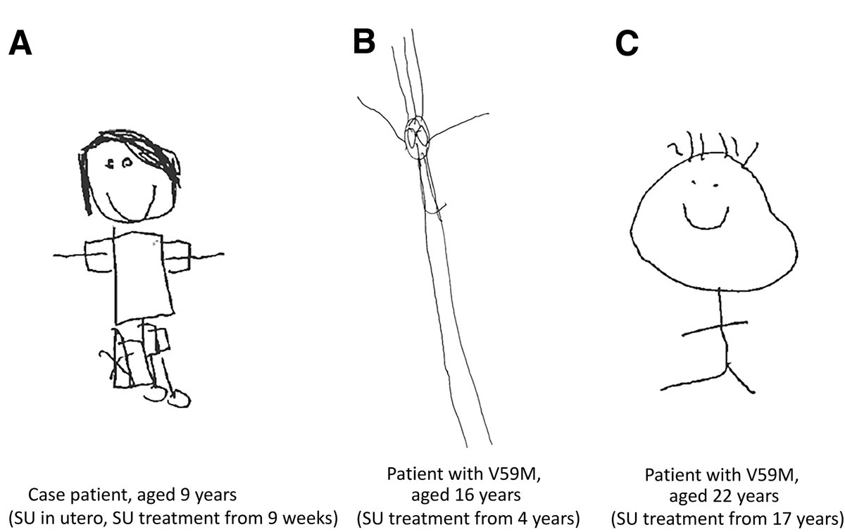 Improved neurodevelopmental outcome after serendipitous exposure to glyburide in utero in a patient with KCNJ11 neonatal diabetes: potential for future prenatal treatment of intellectual disability. <a href="/ADA_Pubs/">ADA Professional Publications</a> 

Read Here➡️ diabetesjournals.org/care/lookup/do…