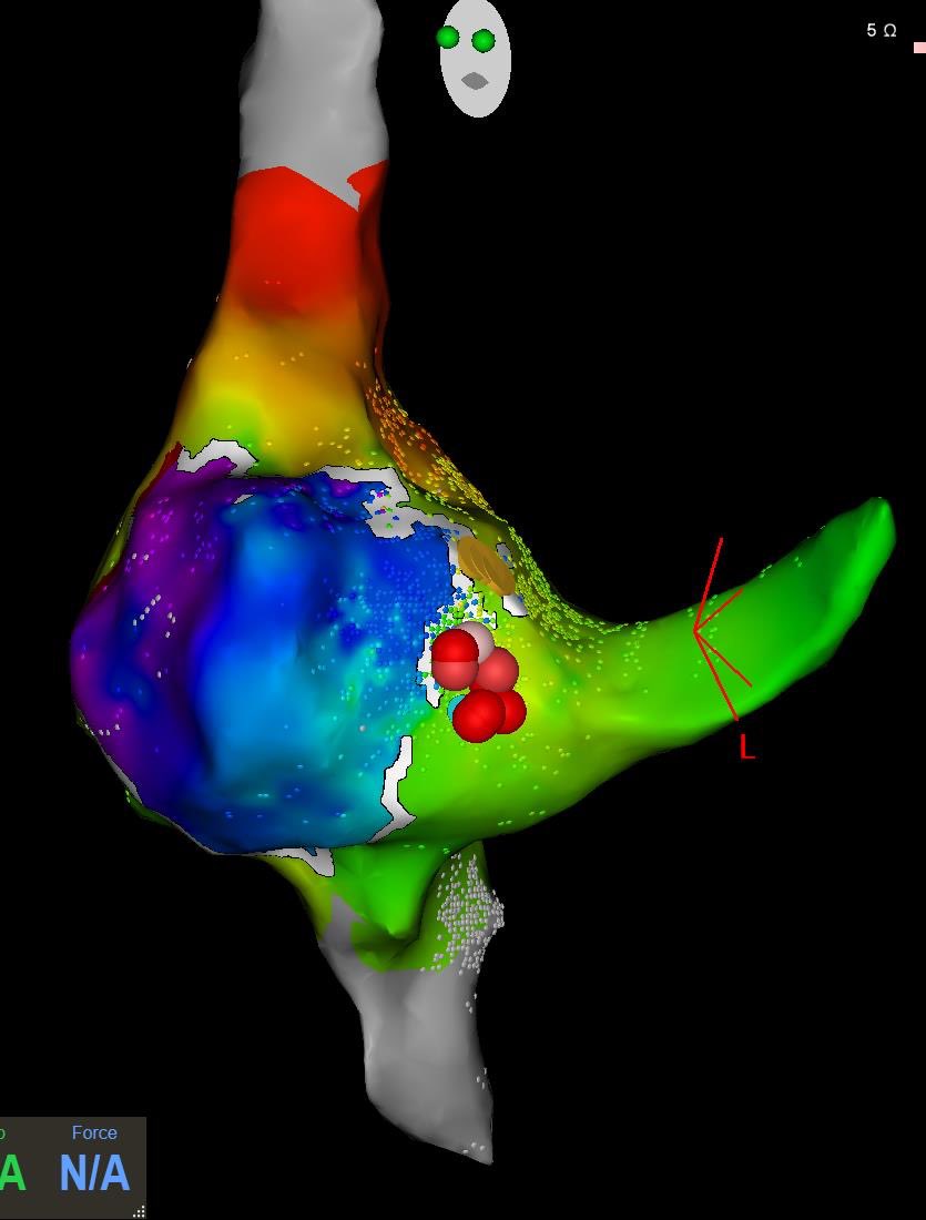 Laila_G's tweet photo. Utility of Open window mapping in complex AP ablation in our 2 last cases: Left lateral WPW with 2 different insertions and Midseptal WPW. #ePeeps #cardiology @julielices  @JLuisMSande @CardiologiaHULA @rafavidalperez 

🧐📖 https://t.co/4ElPWaGbcO https://t.co/zUWARK1Gbr