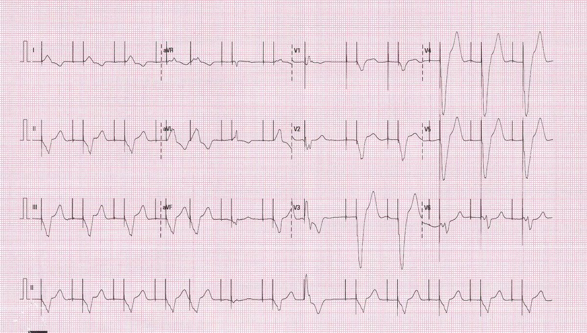 Asymptomatic. On routine ECG? Opinion?