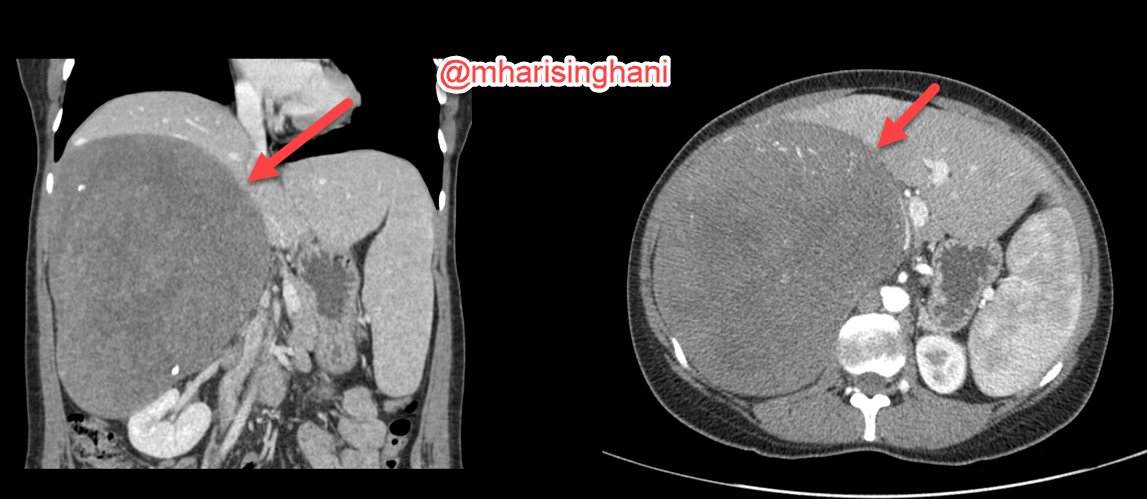 mharisinghani's tweet photo. Large lesion right adrenal; turned out schwannoma https://t.co/nPtJ9NZOnO